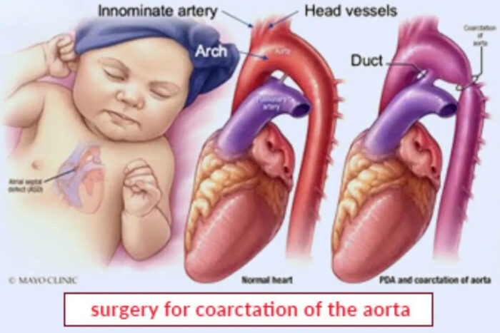 Coarctation Of The Aorta