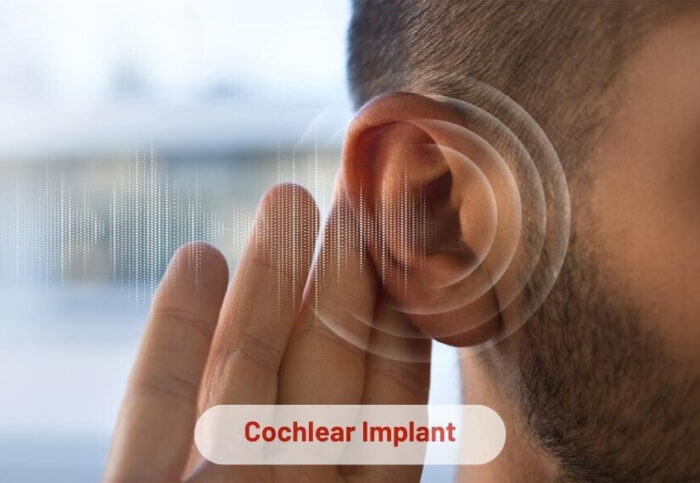 Cochlear Implant Surgery