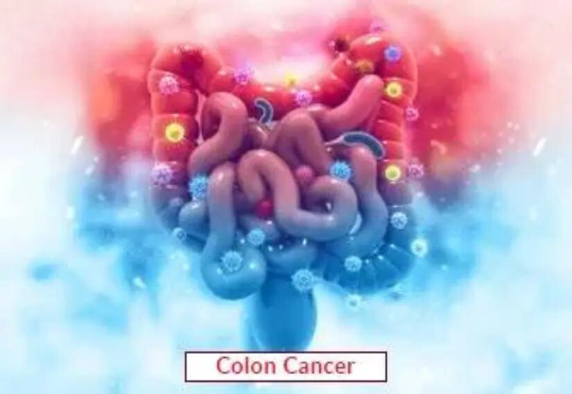 Colon Cancer