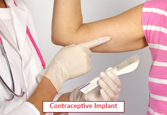 Contraceptive Implant