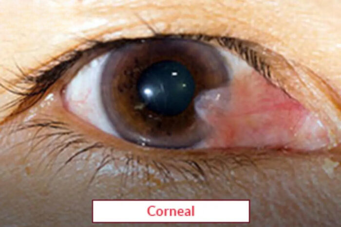 Cornea Transplant Surgery