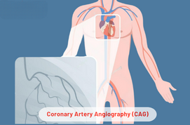 Coronary Artery Angiography (CAG)