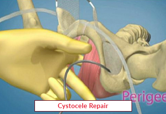 Cystocele Repair