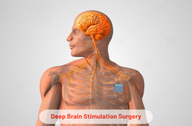 Deep Brain Stimulation Surgery