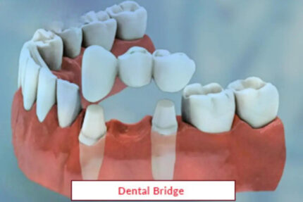 Dental Bridge Treatment