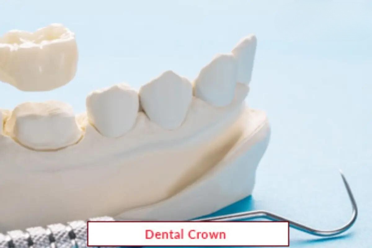 Dental Crown Treatment