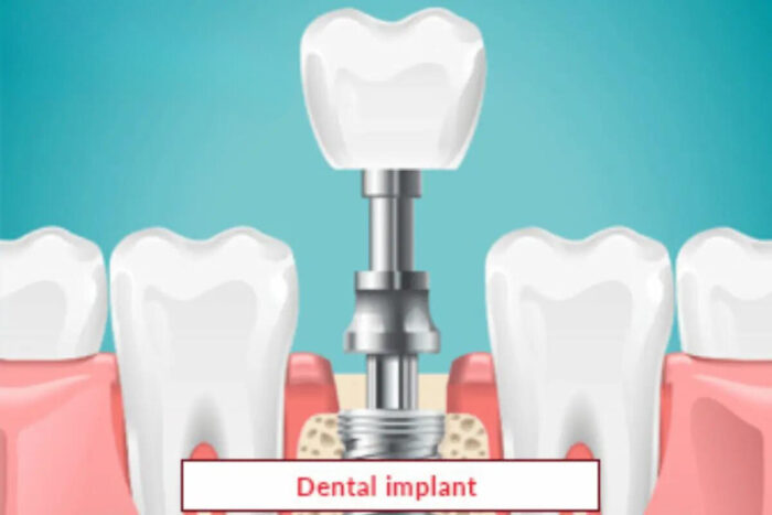 Dental implant Treatment