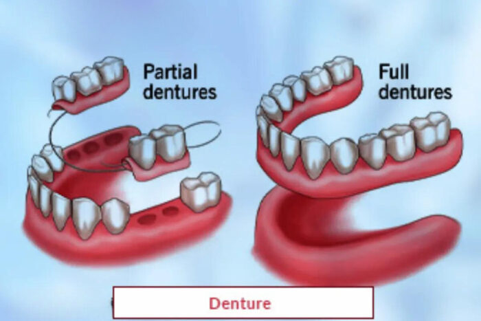 Denture Treatment