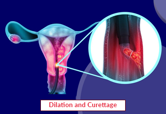 Dilation and Curettage