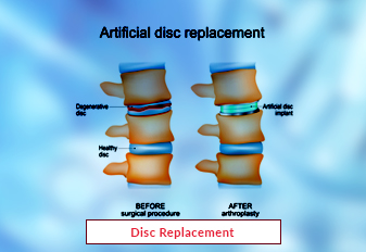 Disc Replacement Surgery