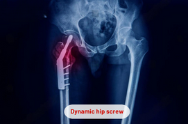 Dynamic Hip Screw