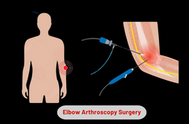 Elbow Arthroscopy Surgery