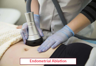 Endometrial Ablation