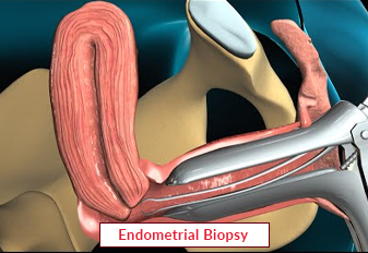 Endometrial Biopsy