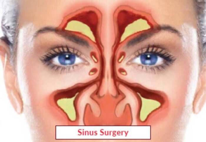 Endoscopic Sinus