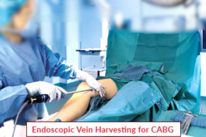 Endoscopic Vein Harvesting