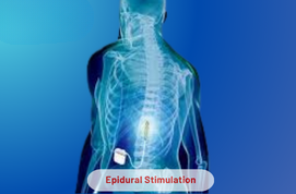 Epidural Stimulation