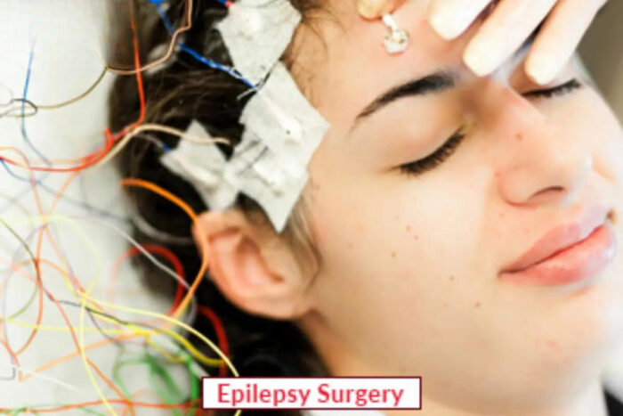 Epilepsy Treatment