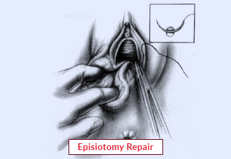 Episiotomy Repair