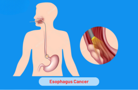 Esophagus Cancer