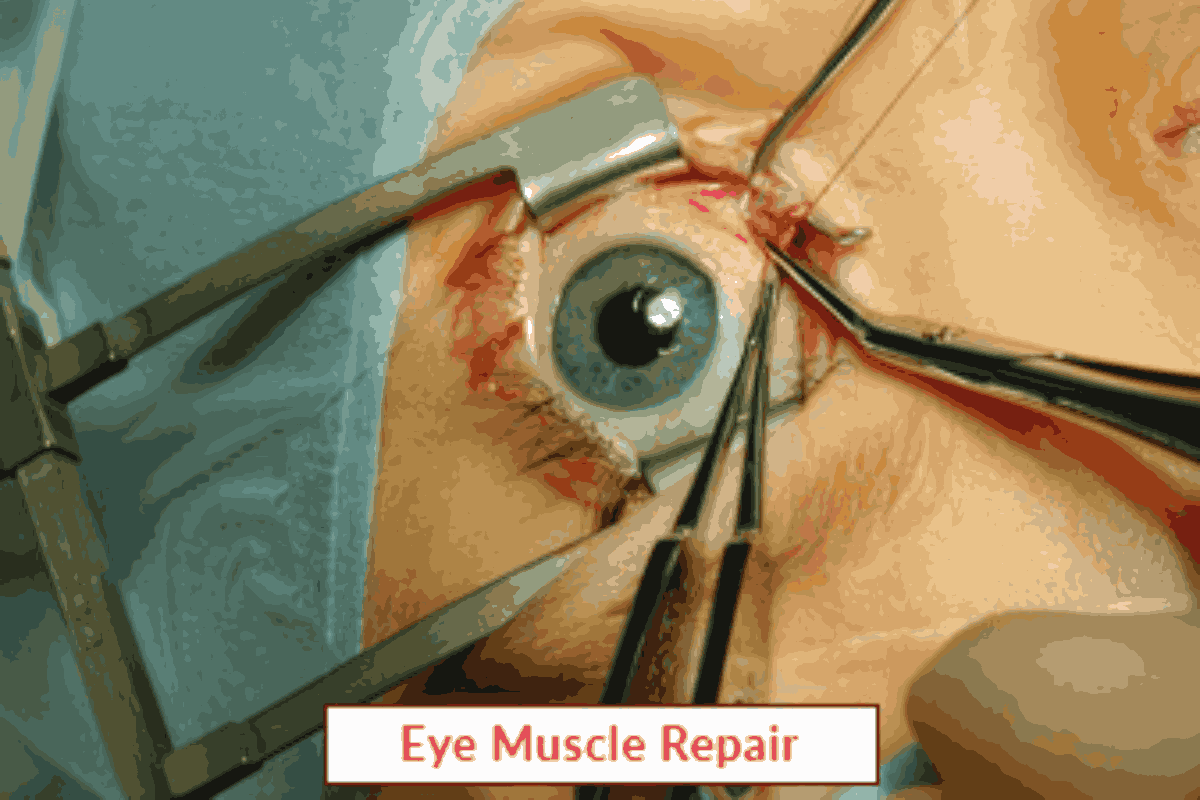 Eye Muscle Repair