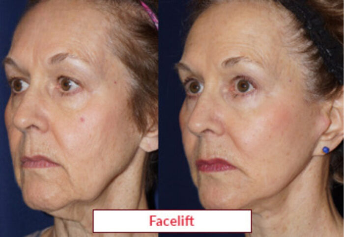 Facelift Surgery