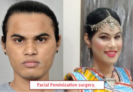 Facial Feminization surgery