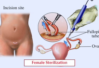 Female Sterilization