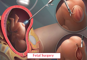 Fetal Surgery