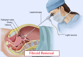 Fibroid Removal