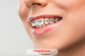 Fixed Braces