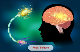 Focal Seizure