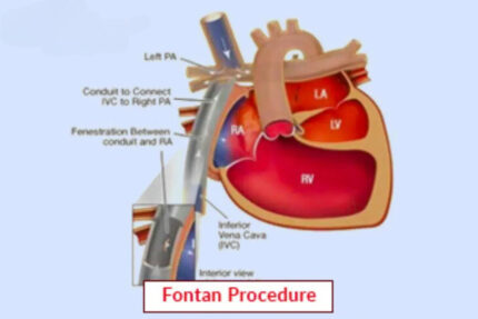 Fontan Procedure