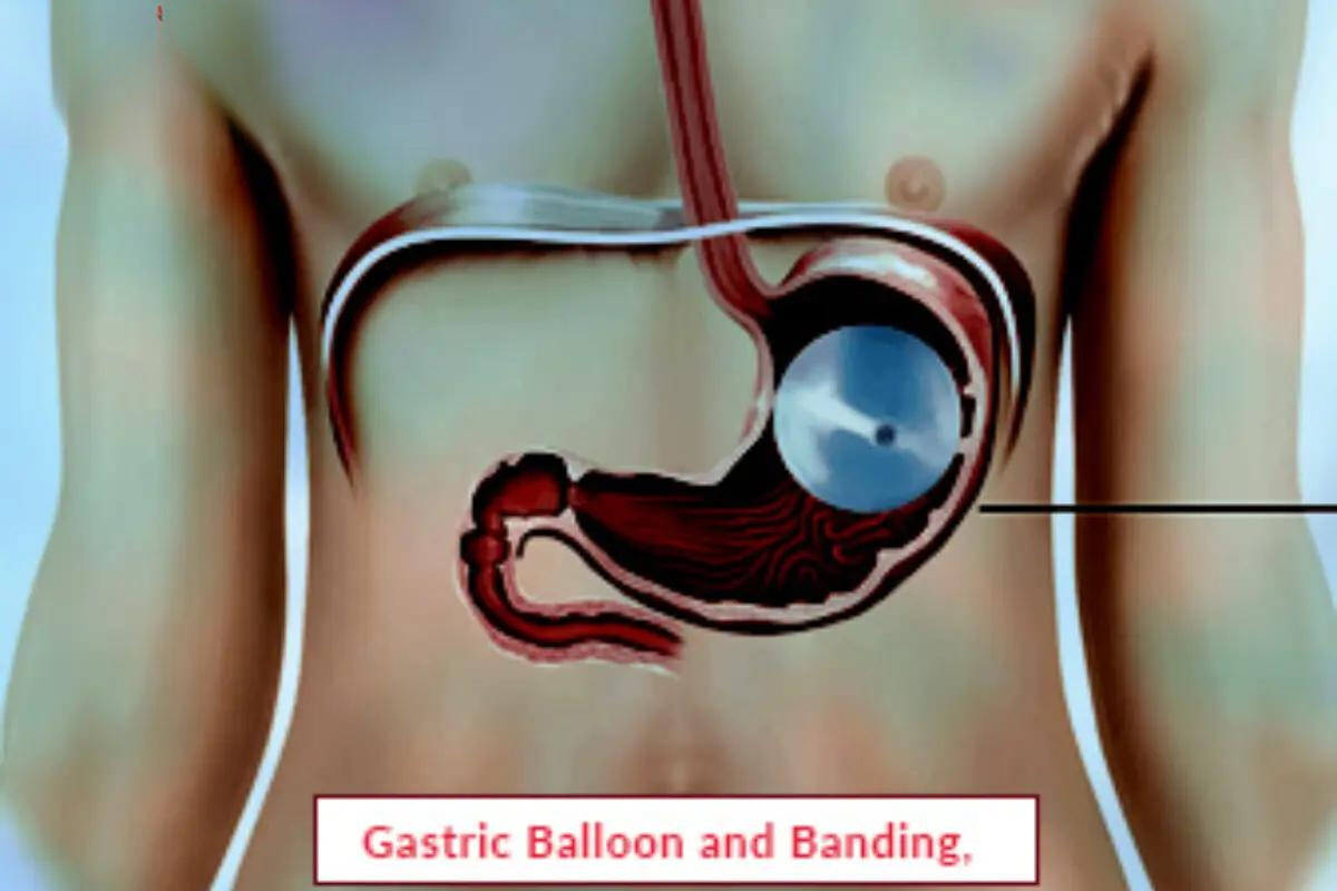 Gastric Balloon