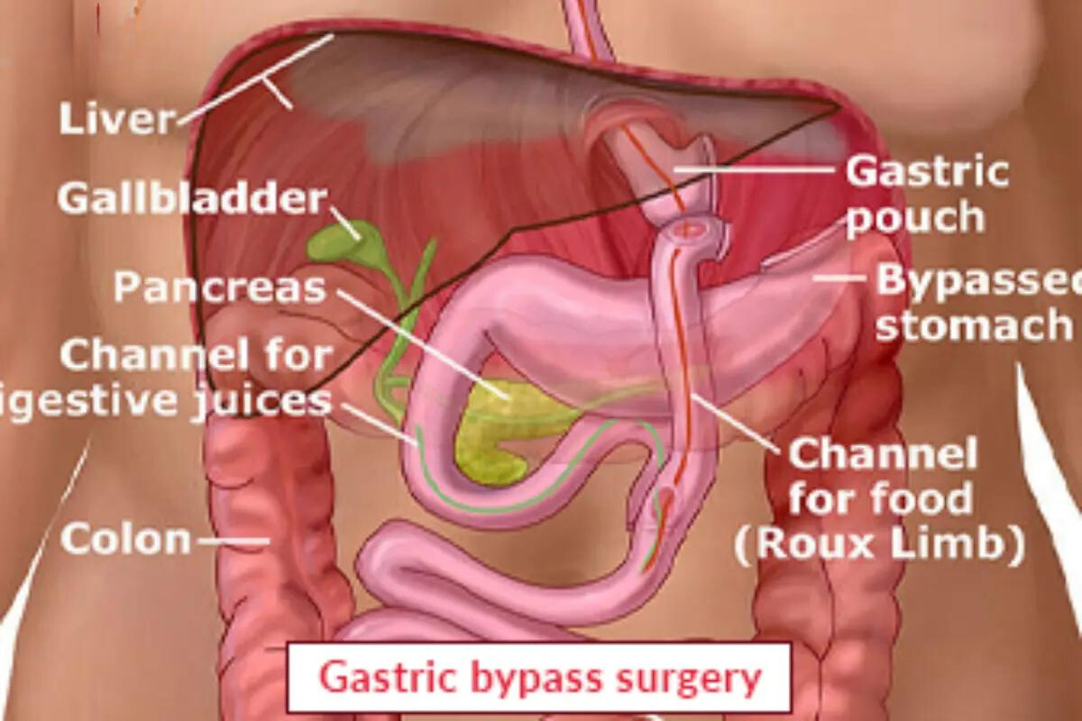 Gastric Bypass Surgery