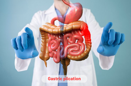 Gastric Plication