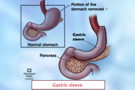 Gastric sleeve