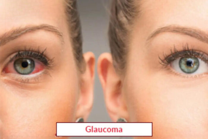 Glaucoma Surgery