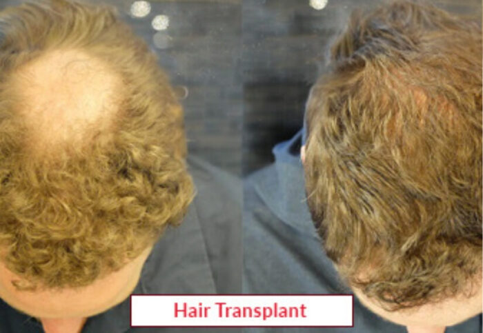 Hair Transplant