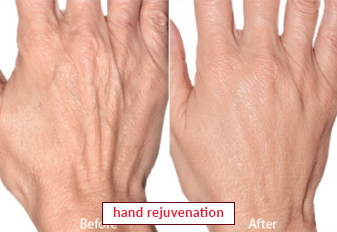 Hand Rejuvenation