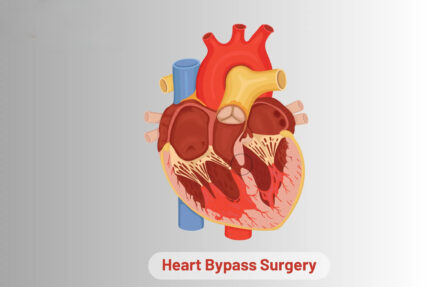 Heart Bypass Surgery