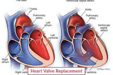 Heart Valve Repair