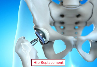 Hip Replacement