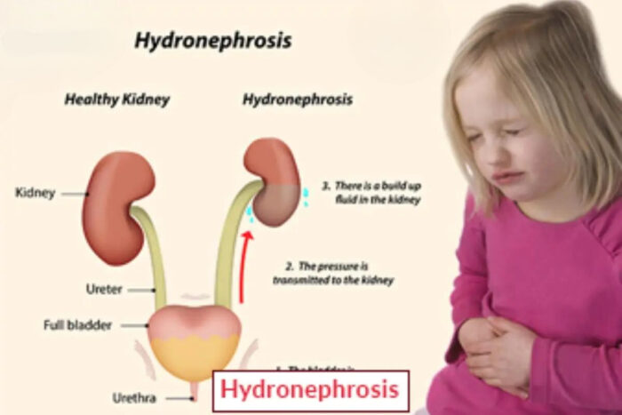 Hydronephrosis Treatment