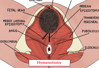 Hymenotomy