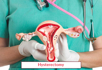 Hysterectomy