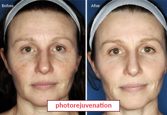 IPL Photorejuvenation Treatment