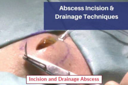 Incision and Drainage Abscess