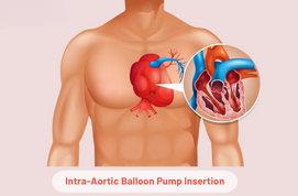 Intra-Aortic Balloon Pump Insertion