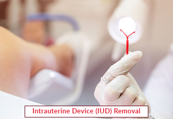 Intrauterine Device (IUD) Removal